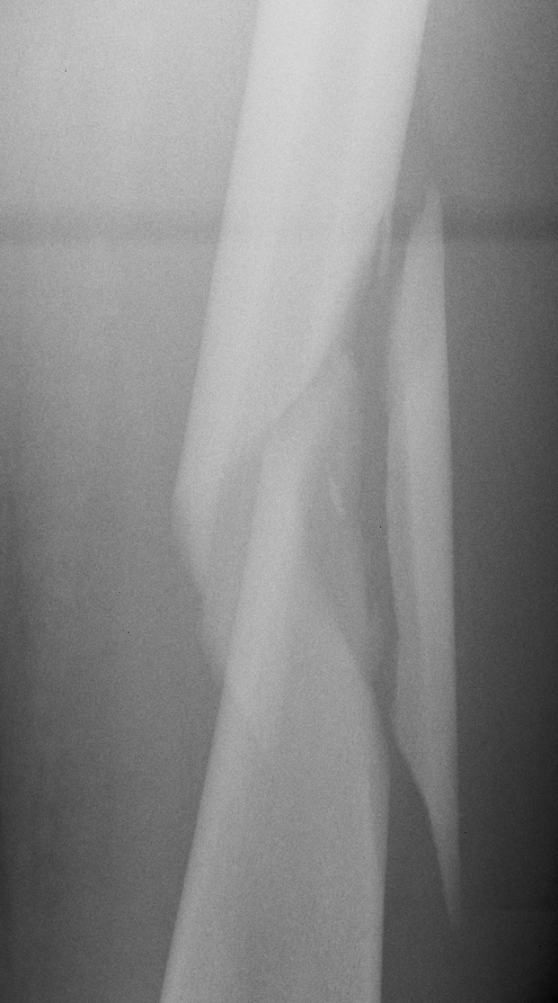 Femoral fracture